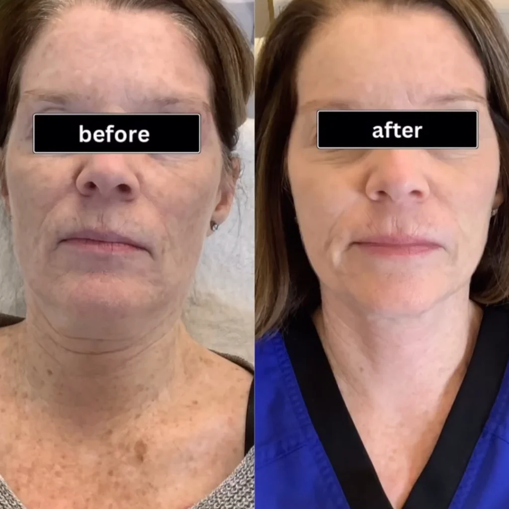 Moxi Treatment Before & After Photos | Monroe MedSpa